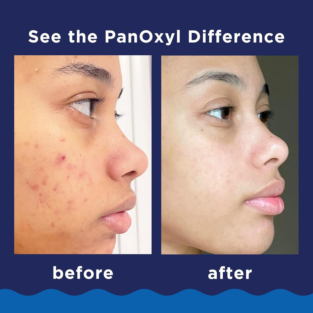 PanOxyl 10% Benzoyl Peroxide Acne Wash