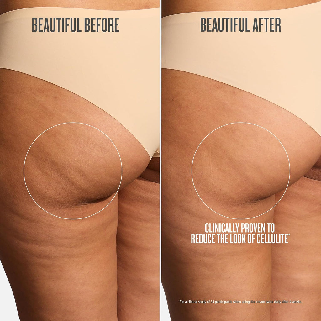 Before and after comparison of cellulite reduction on a person's thigh.
