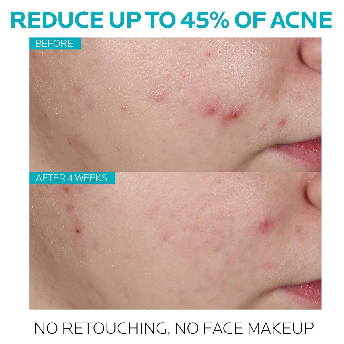 Before-and-after acne treatment results on a person's cheek, showing visible red acne lesions in the top 'Before' panel and clearer skin in the bottom 'After 4 Weeks' panel. Large text at the top reads 'REDUCE UP TO 45% OF ACNE' and text at the bottom reads 'NO RETOUCHING, NO FACE MAKEUP'.