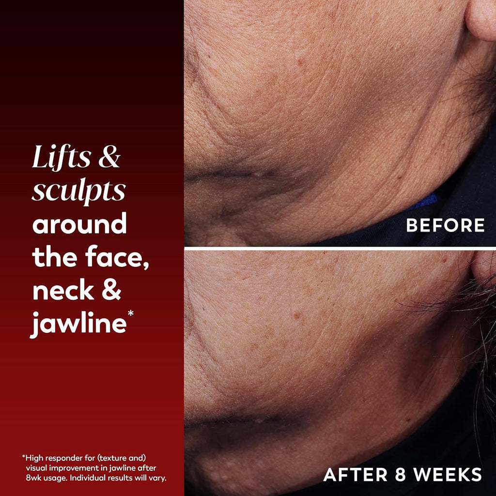 Before-and-after comparison of facial and neck skin texture, showing wrinkles around the face, neck, and jawline. The top panel is labeled BEFORE and shows drier, more textured skin.
