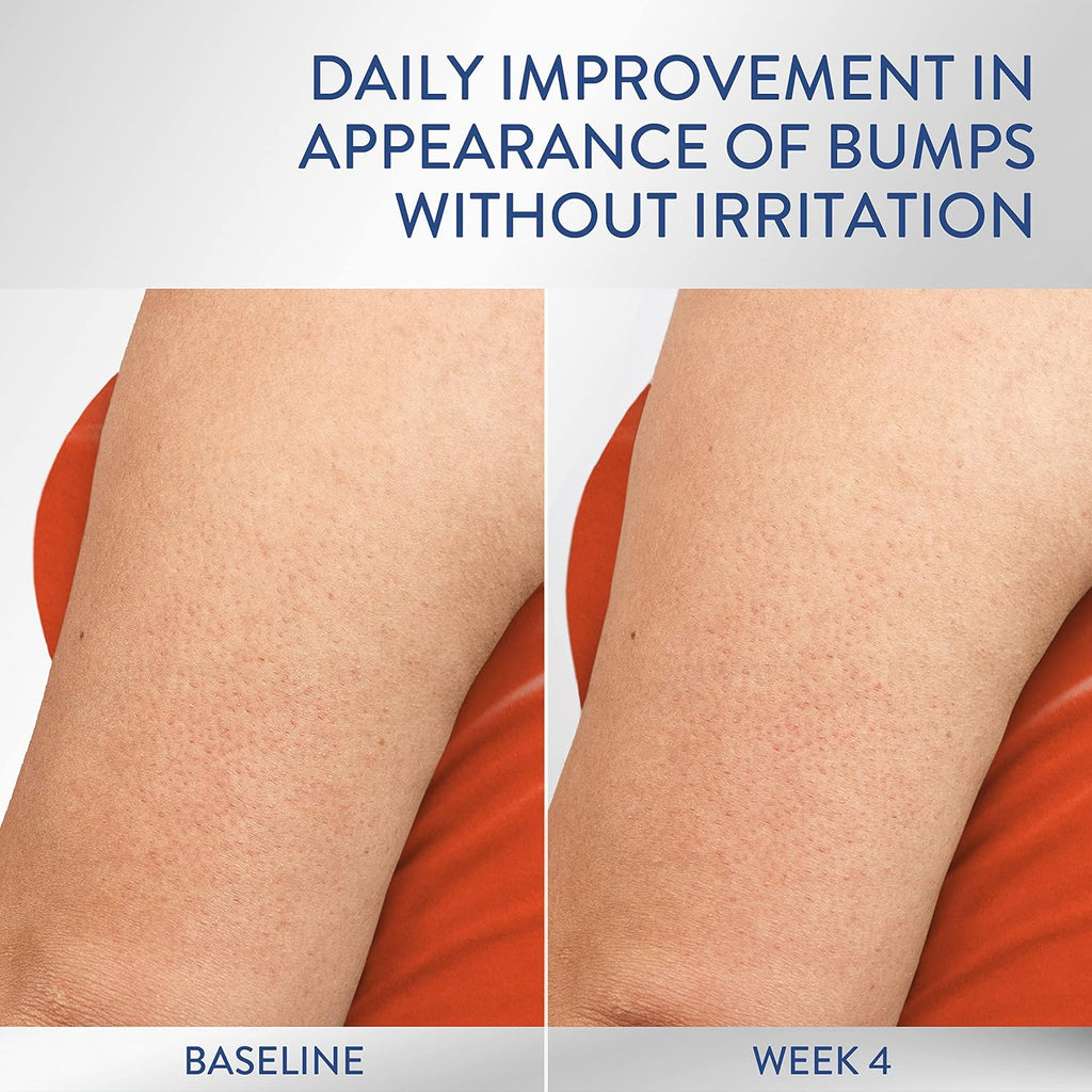 Before-and-after comparison of skin texture on an arm, labeled 'BASELINE' and 'WEEK 4', with the headline 'DAILY IMPROVEMENT IN APPEARANCE OF BUMPS WITHOUT IRRITATION' at the top.