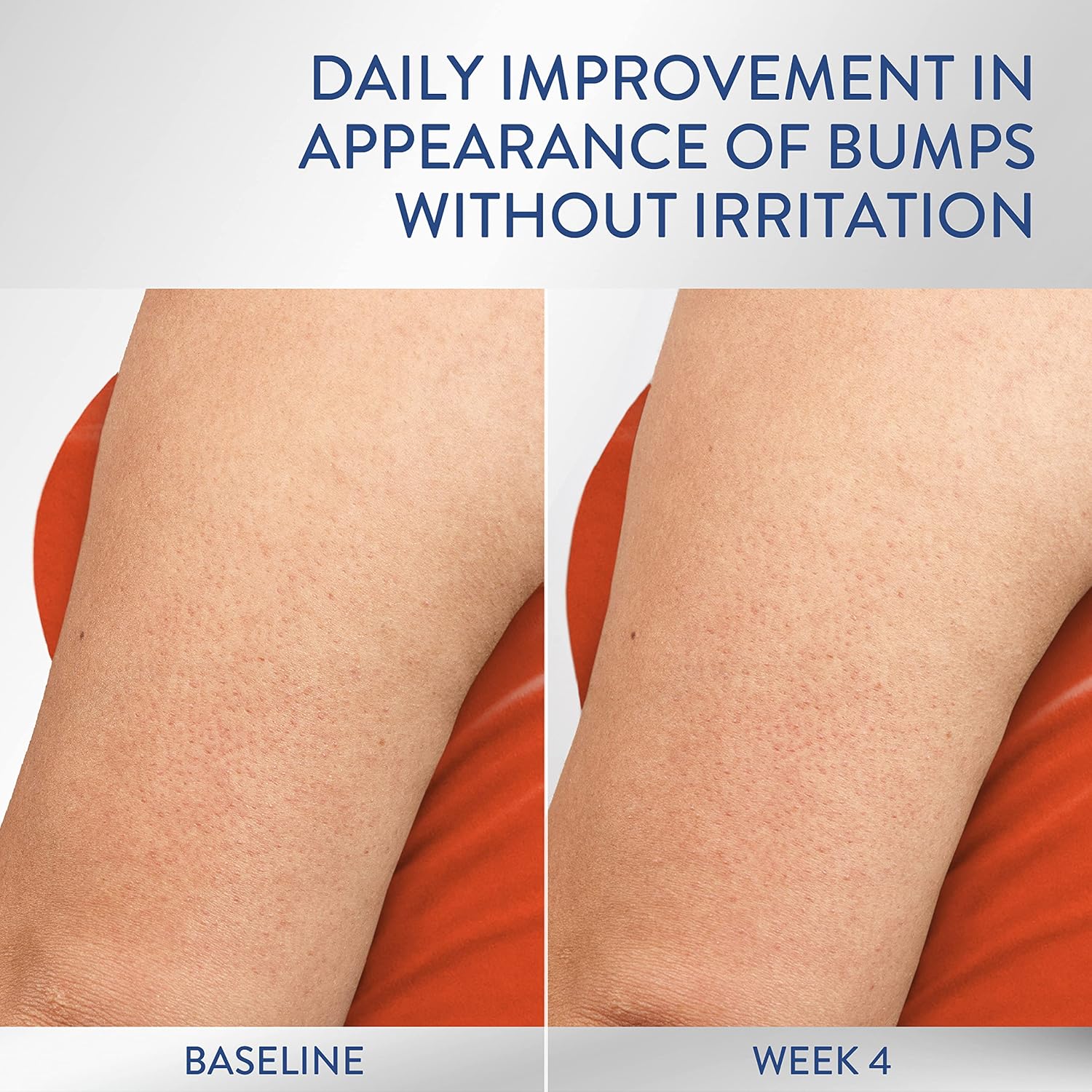 Before-and-after comparison of skin texture on an arm, labeled 'BASELINE' and 'WEEK 4', with the headline 'DAILY IMPROVEMENT IN APPEARANCE OF BUMPS WITHOUT IRRITATION' at the top.