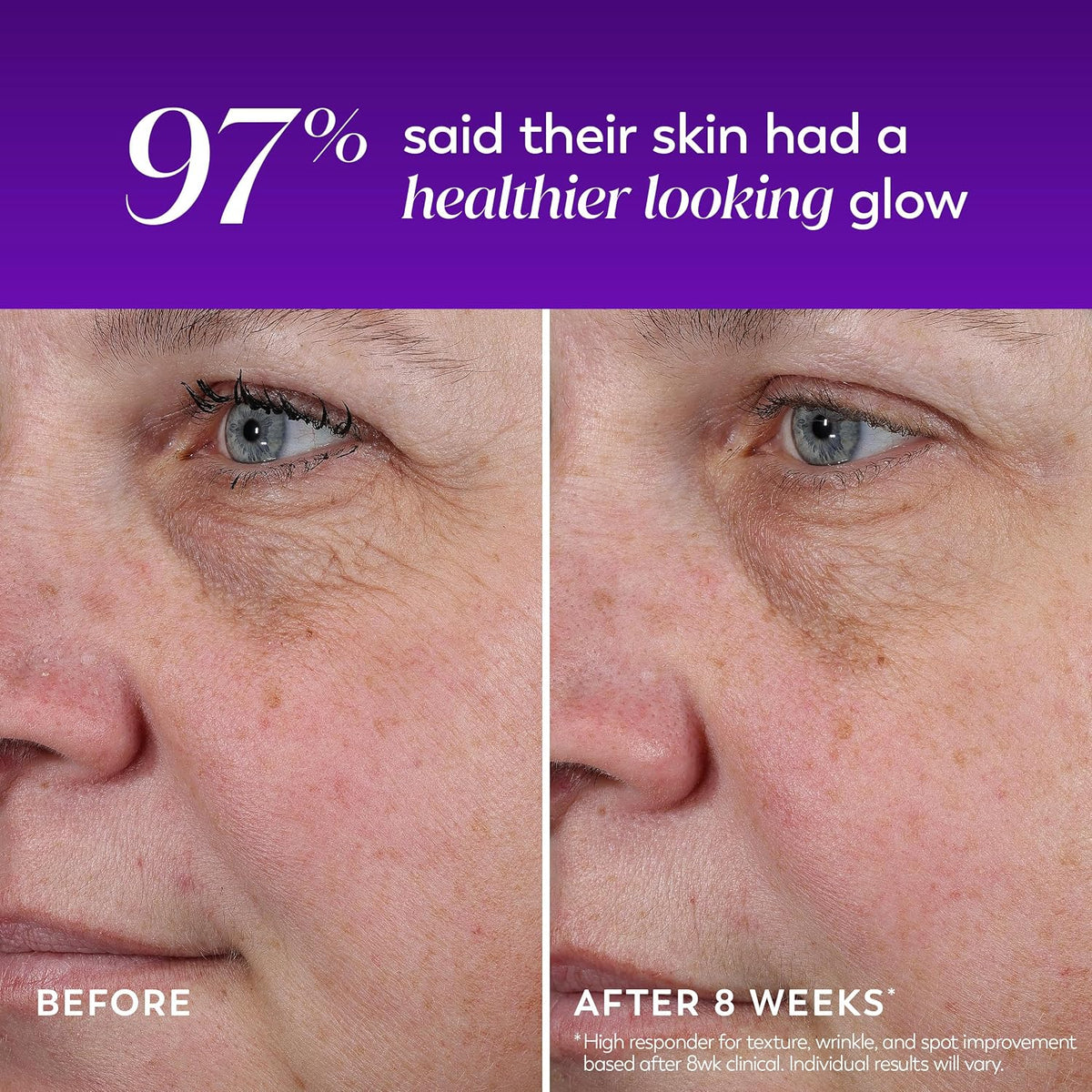 Before and after comparison of a person's eye area with text indicating improvement.