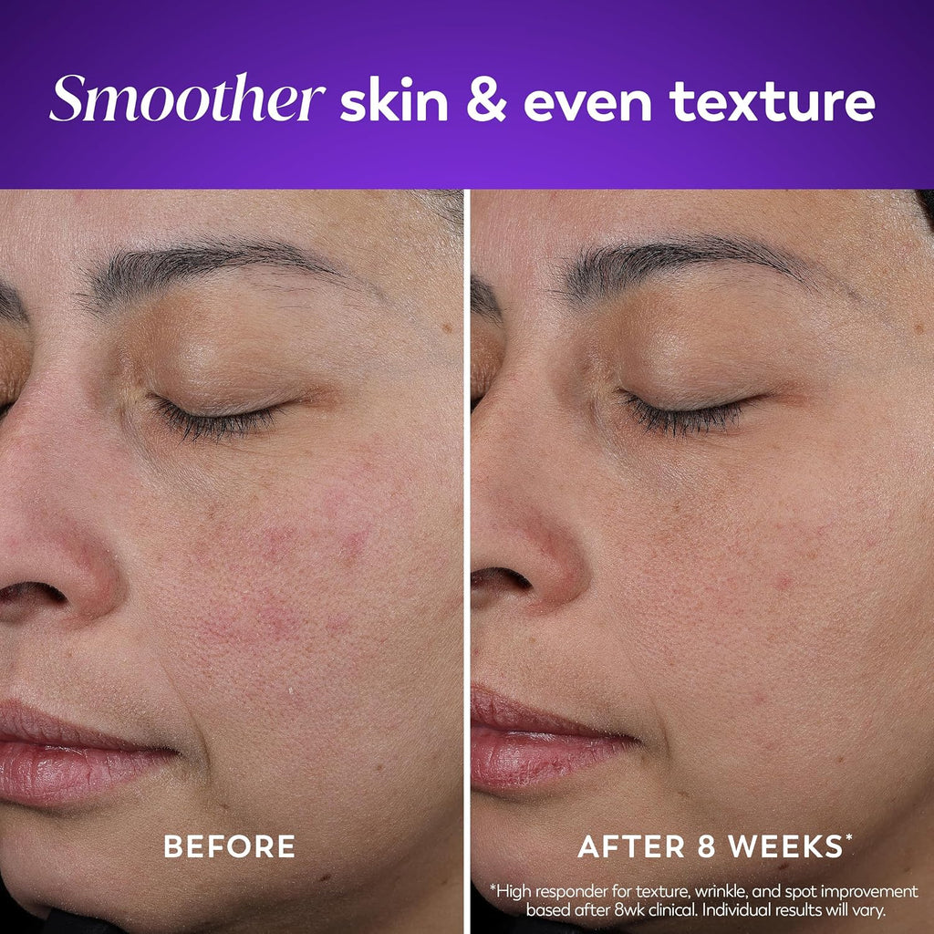 Before and after comparison of smoother skin texture on a person's face.