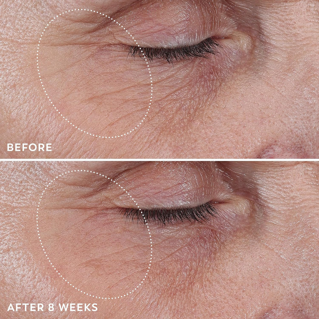 Before and after comparison of eye area skin texture with a focus on wrinkles.