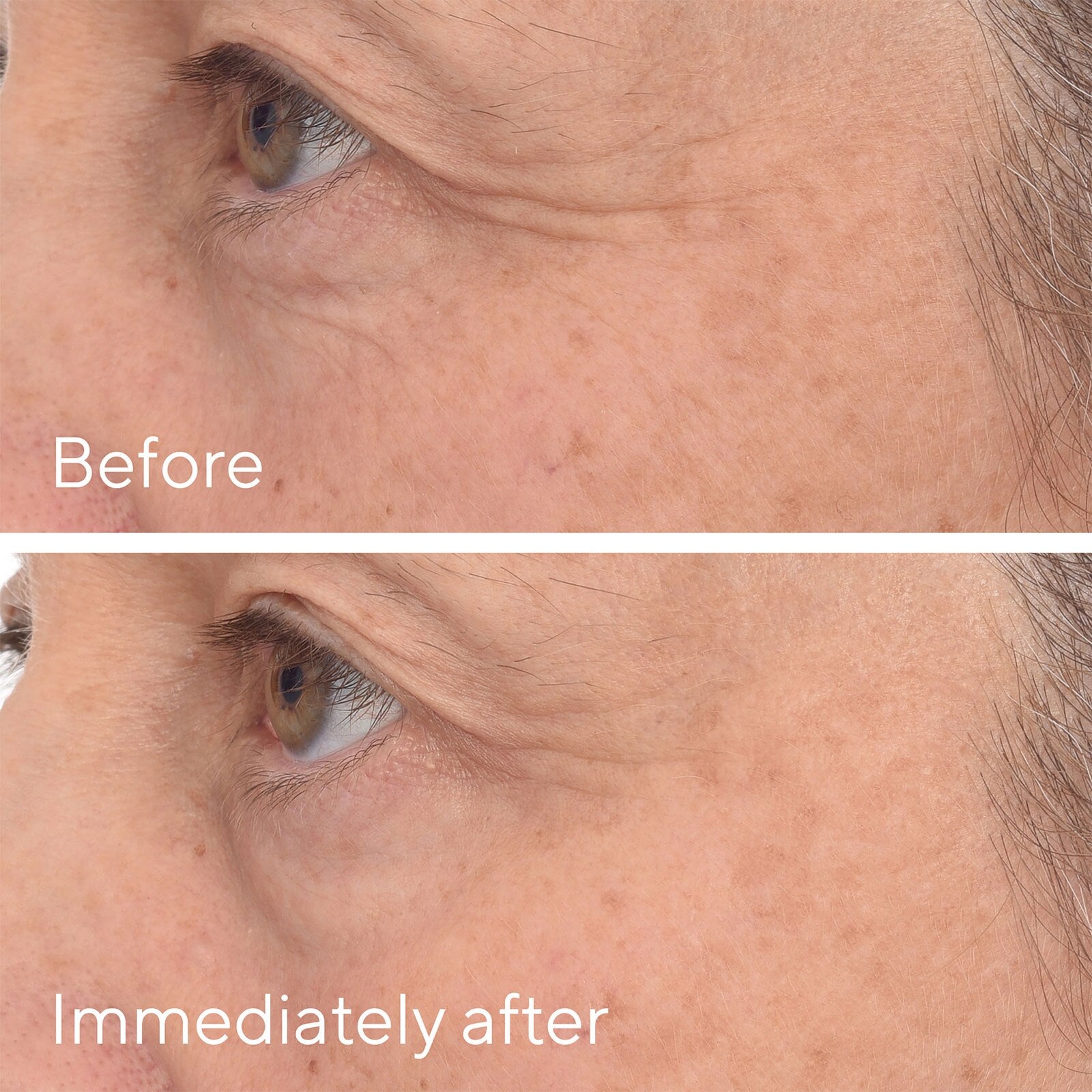 Before-and-after close-up comparison of a person's eye and cheek skin, showing wrinkle reduction over time. The top panel is labeled 'Before' and the bottom panel is labeled 'Immediately after'.