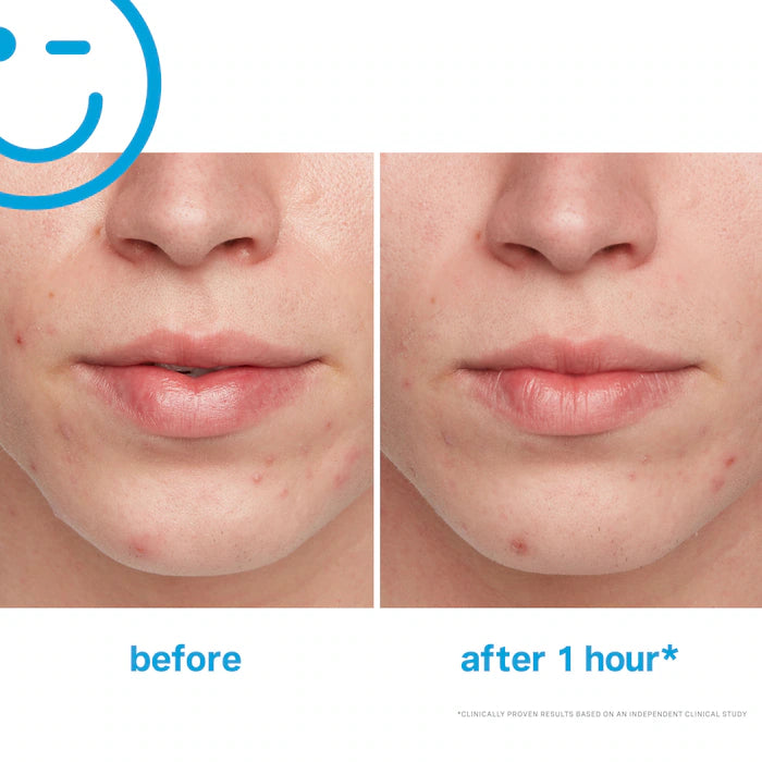 EradiKate™ Acne Spot Treatment with 10% Sulfur