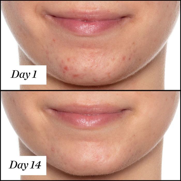 Sunday Riley - U.F.O. Salicylic Acid BHA Acne Treatment Face Oil