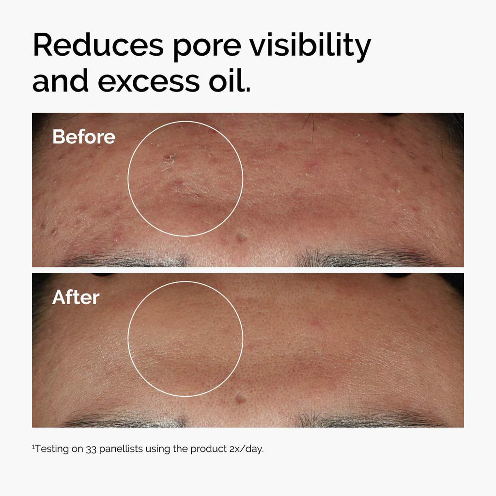 
The Ordinary 
Niacinamide 10% + Zinc 1%  Serum for Oily Skin