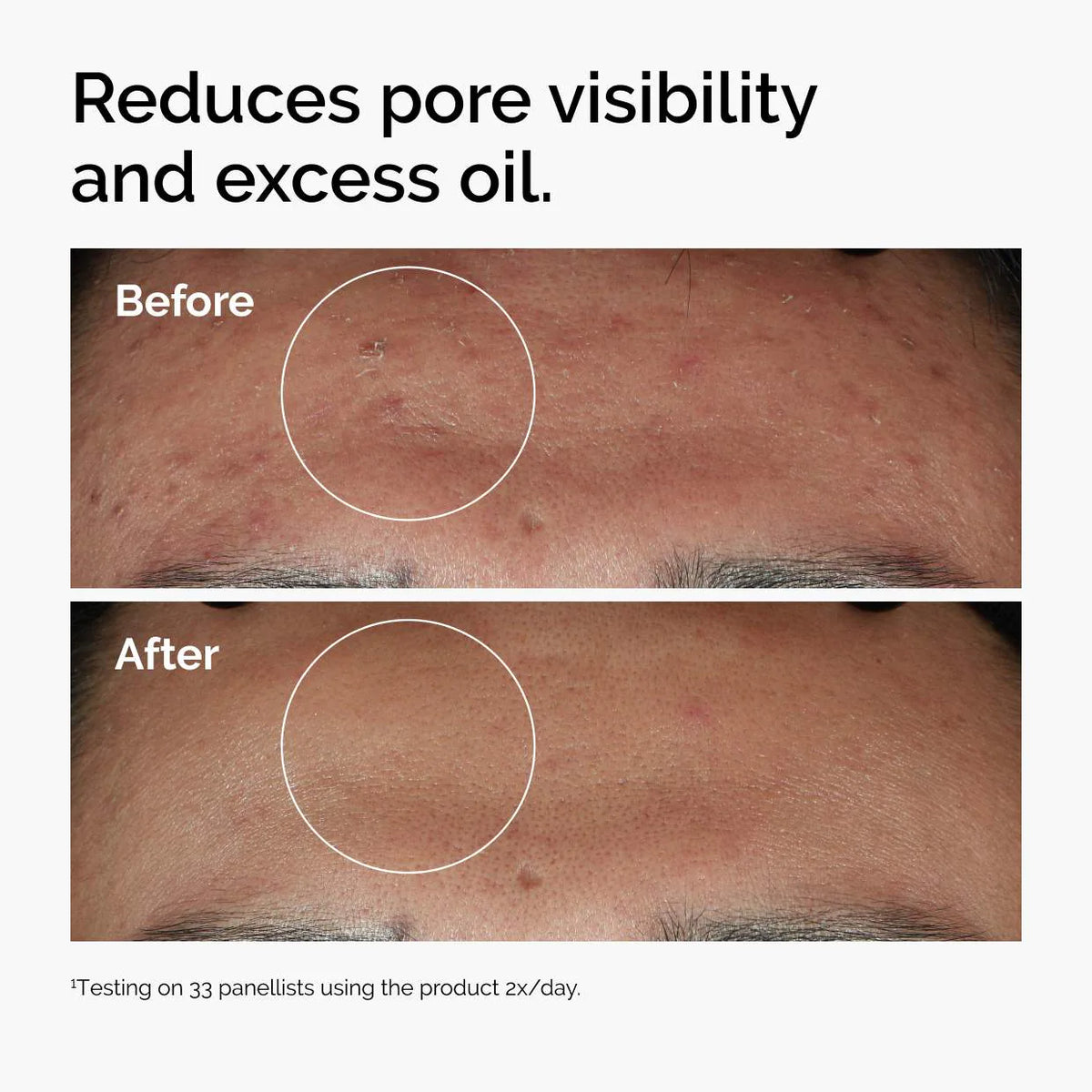 
The Ordinary 
Niacinamide 10% + Zinc 1%  Serum for Oily Skin