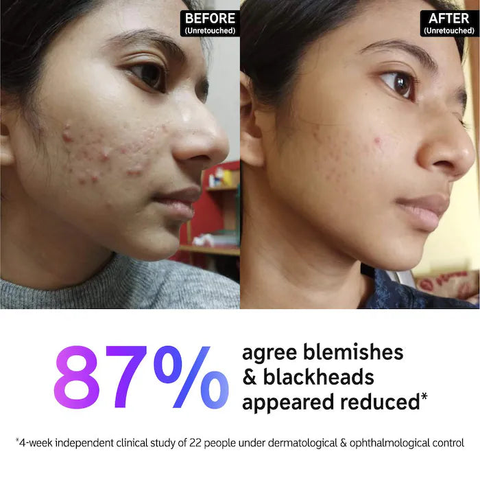 Salicylic Acid Acne + Blackhead Cleanser
