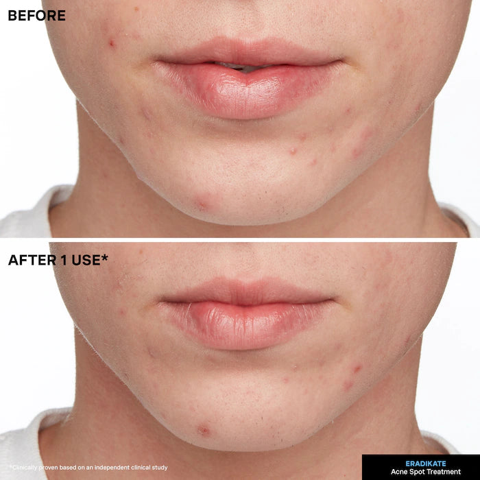 EradiKate™ Acne Spot Treatment with 10% Sulfur