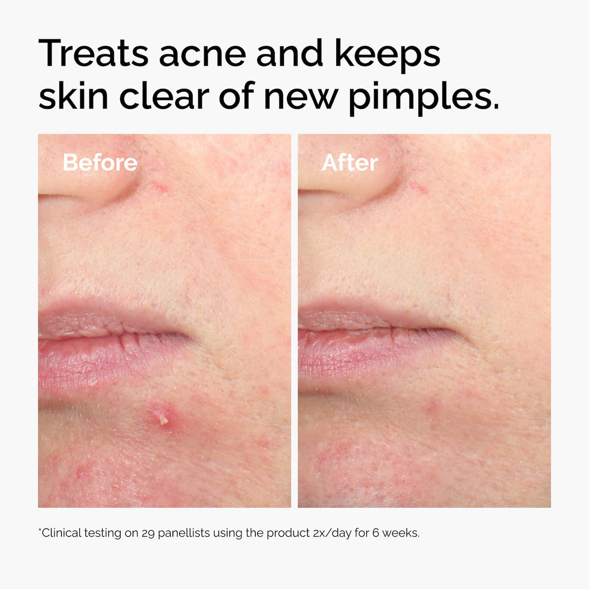 The Ordinary 
Salicylic Acid 2% Solution, Exfoliating Serum for Acne
