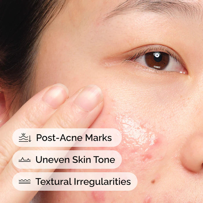 The Ordinary - Aloe 2% + NAG 2% Solution for Post-Acne Marks