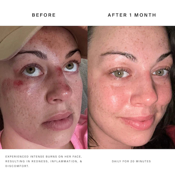 HigherDOSE - Red Light Face Mask for Fine Lines & Glowing Skin