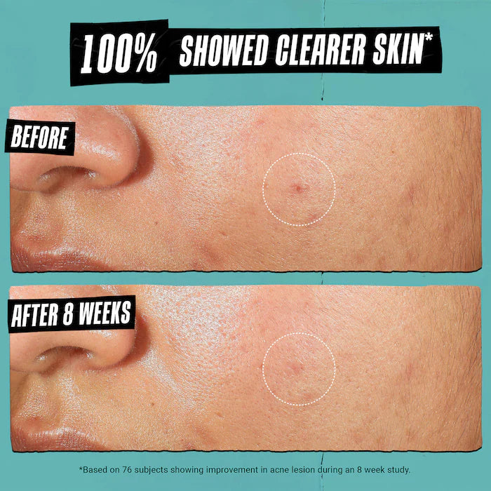 Expertly Clear Acne Treating & Preventing Face & Body Moisturizer with Salicylic Acid﻿