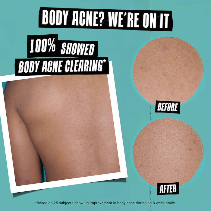 Expertly Clear Acne Treating & Preventing Face & Body Moisturizer with Salicylic Acid﻿