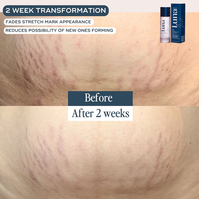 Luna Daily - The Skin Support Oil - For Stretch Marks, Hyperpigmentation & Uneven Skin Texture