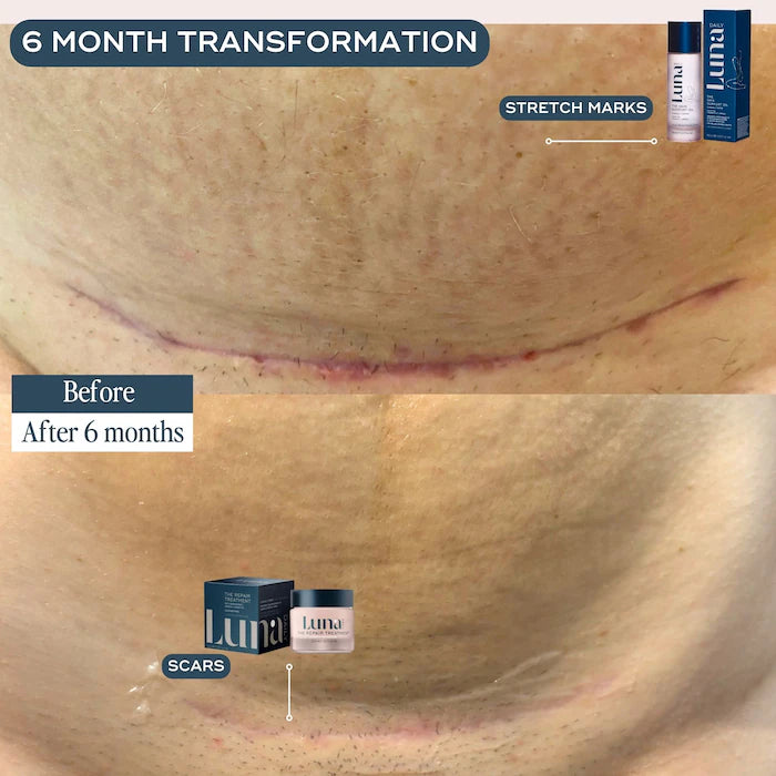 Luna Daily - The Skin Support Oil - For Stretch Marks, Hyperpigmentation & Uneven Skin Texture