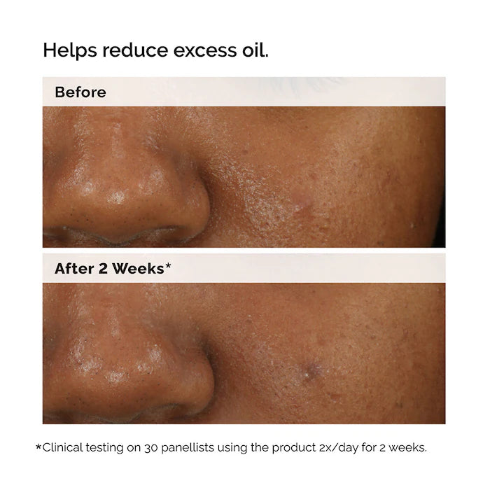 The Ordinary - Balancing & Clarifying Serum for Oily Skin and Pore Refinement