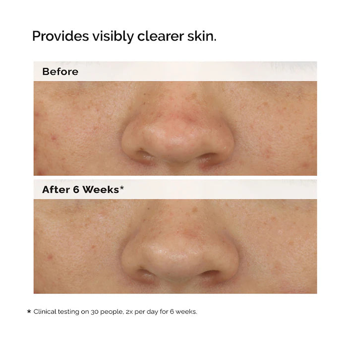 The Ordinary - Balancing & Clarifying Serum for Oily Skin and Pore Refinement