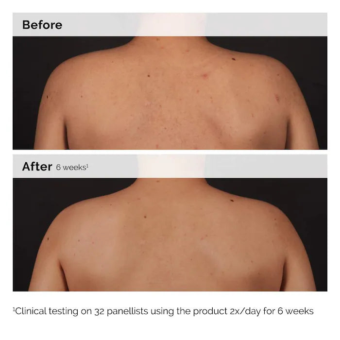  The Ordinary - Salicylic Acid 0.5% Body Serum Exfoliating Treatment for Acne
