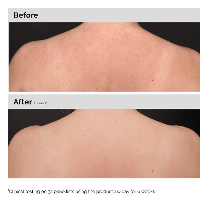  The Ordinary - Salicylic Acid 0.5% Body Serum Exfoliating Treatment for Acne