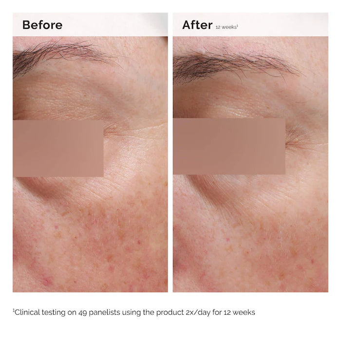  The Ordinary - Niacinamide 5% Face and Body Emulsion for Dark Spots & Uneven Tone