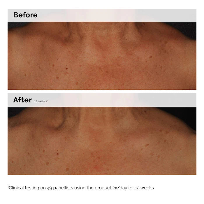  The Ordinary - Niacinamide 5% Face and Body Emulsion for Dark Spots & Uneven Tone