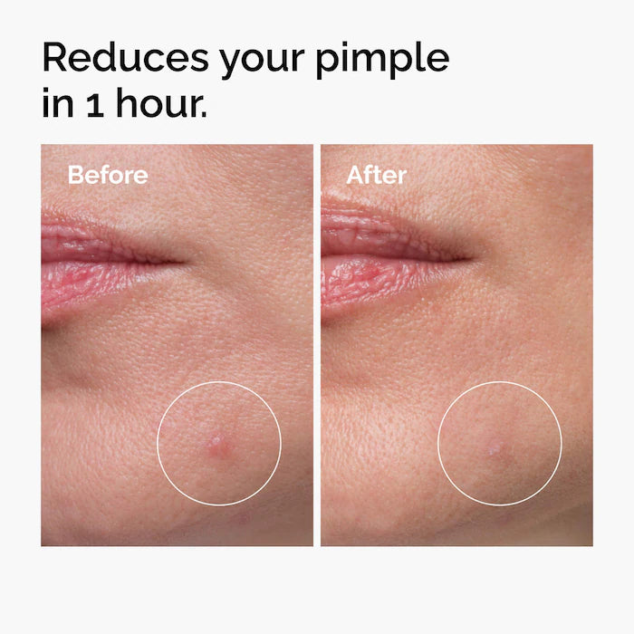 The Ordinary - Sulfur 10% Powder-to-Cream Concentrate Acne Spot Treatment
